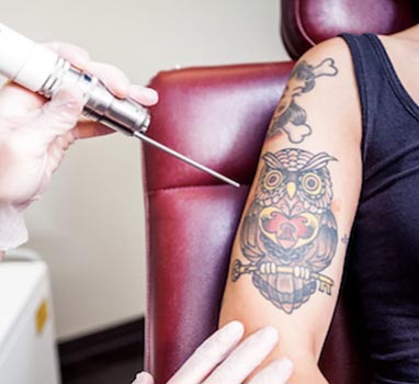 Laser tattoo removal faux beauty crawley