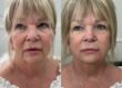 Visible results of anti-ageing on a lady in her 50s using dermal fillers and skin boosters in Surrey & Sussex.