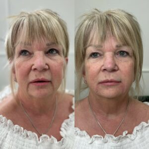 Dermal filler Crawley West Sussex