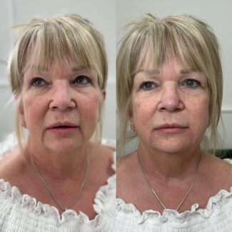 Visible results of anti-ageing on a lady in her 50s using dermal fillers and skin boosters in Surrey & Sussex.