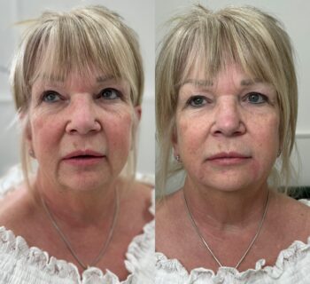 Dermal filler Crawley West Sussex