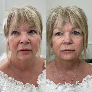 Visible results of anti-ageing on a lady in her 50s using dermal fillers and skin boosters in Surrey & Sussex.