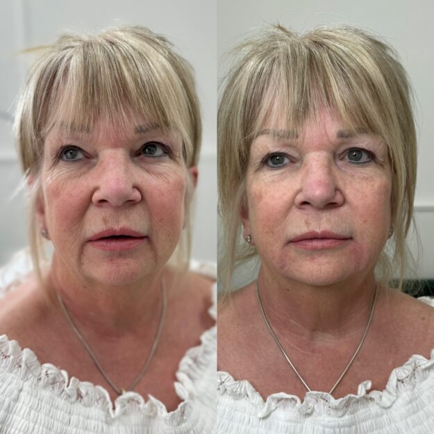 Visible results of anti-ageing on a lady in her 50s using dermal fillers and skin boosters in Surrey & Sussex.
