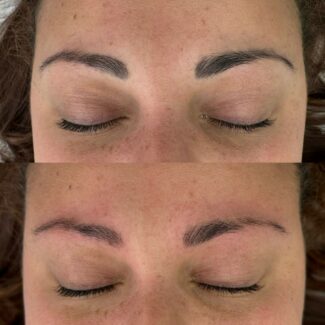 Microblading removal Crawley West Sussex