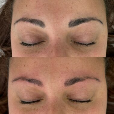 Microblading removal Crawley West Sussex