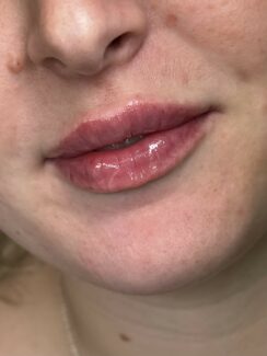 Lip Filler Crawley West Sussex