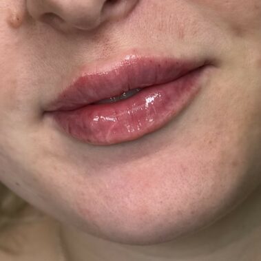 Lip Filler Crawley West Sussex