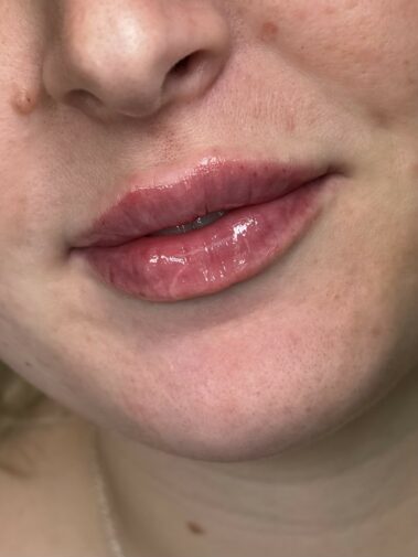Lip Filler Crawley West Sussex