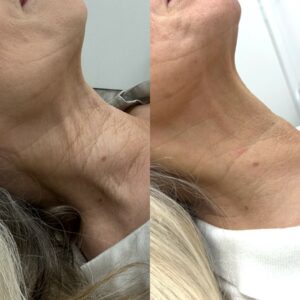 Skin boosters for the neck 