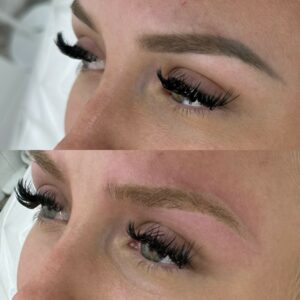 Laser tattoo removal for semi permanent makeup 