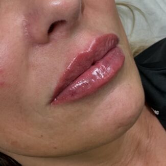 Natural lip fillers Crawley West Sussex