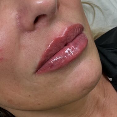 Natural lip fillers Crawley West Sussex