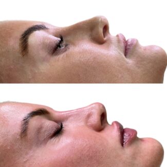 Liquid rhinoplasty, nose filler, Crawley West Sussex