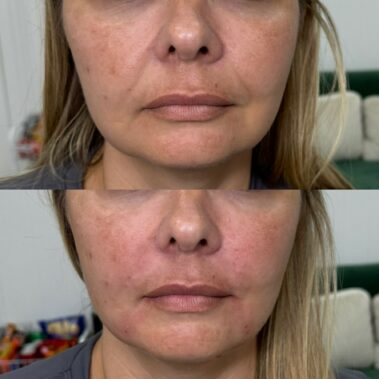 Smile line filler Crawley