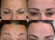 botox injections in Oxted & Crawley