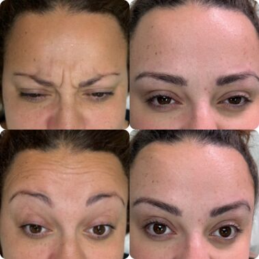 botox injections in Oxted & Crawley