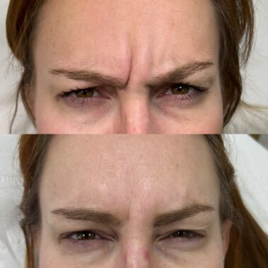Botox to treat strong frown lines