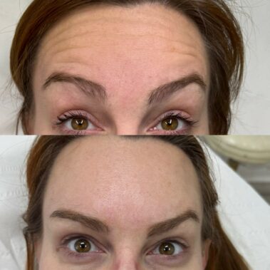 Botox for forehead lines