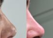 Nose filler also known as liquid nose job or liquid rhinoplasty in Oxted, surrey & Crawley, West Sussex.