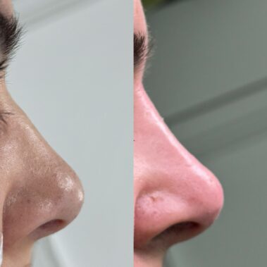 Nose filler also known as liquid nose job or liquid rhinoplasty in Oxted, surrey & Crawley, West Sussex.