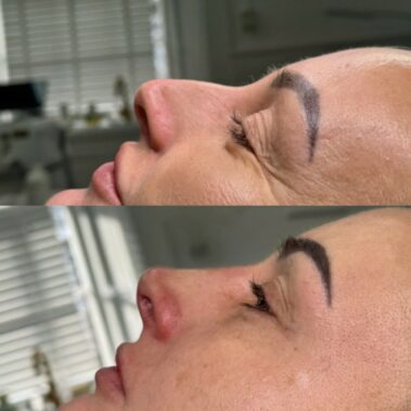 Nose filler to give a liquid nose job