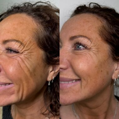 Results of just one session of Polynucleotides using Vitaran.