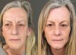 Womans results of Sculptra anti-ageing skin treatment looking visibly younger.