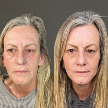 Womans results of Sculptra anti-ageing skin treatment looking visibly younger.