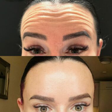 Results after botox wrinkle relaxing injections in Crawley West Sussex.