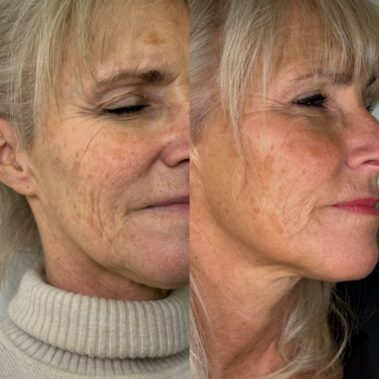 Woman looking visibly younger after one session of seventy hyal skin booster in Oxted Surrey.