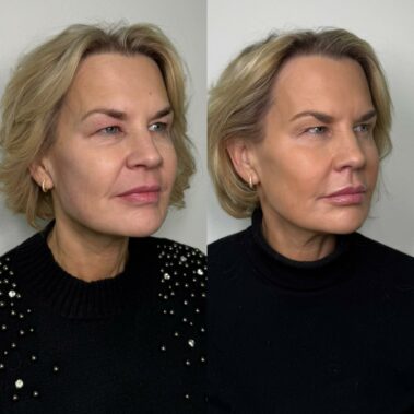 Woman looking visibly younger from the effects of skin booster profhilo structura
