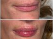 Lip filler in Oxted Surrey