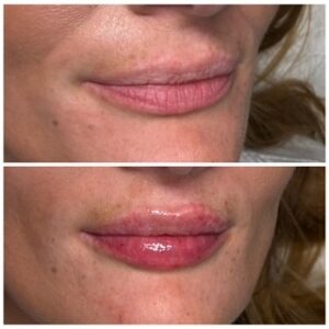 Lip filler in Oxted Surrey 