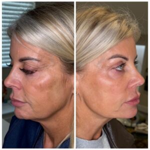 Skin tightening in Oxted Surrey